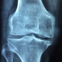 Joint Replacement and Outpatient Surgery
